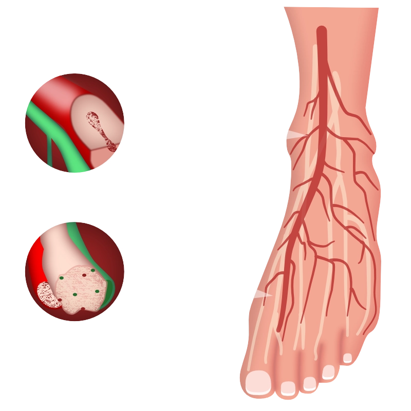 Graphic showing the damaging effects of diabetes on nerves and blood flow